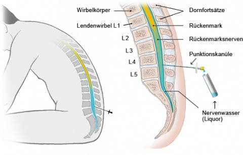 Lumbalpunktion: Entnahme des Liquors (aus gesundheitsinformation.de)