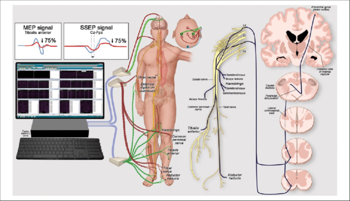 Somatosensorische Potentiale des N. tibialis und medianus/ MEP, schematische Darstellung (aus researchgate.net)